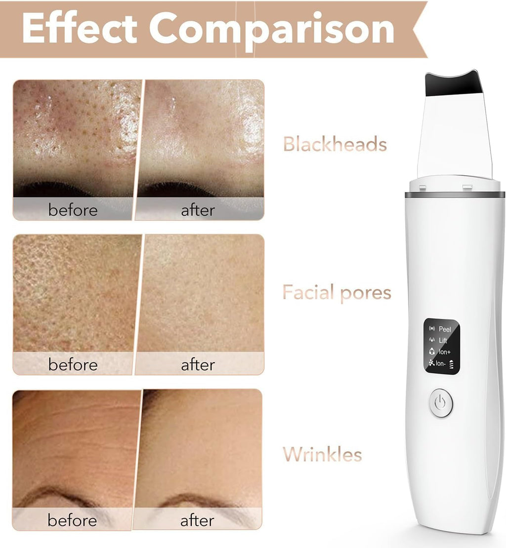 Ultrasonic Blackhead Remover Exfoliating Device, Deep Pore Cleansing, Deep Cleansing Facial Cleansing, 4 Modes Blackhead Removal, Rechargeable by